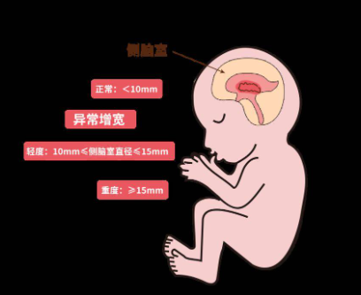 侧脑室增宽5天后被吸收是正常现象