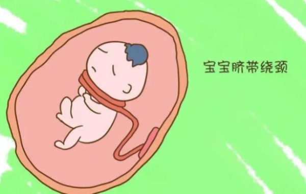 胎儿脐带绕颈不能说明有福气