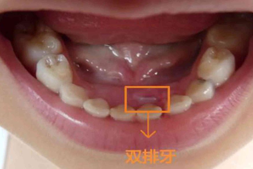 10-12岁更换尖牙