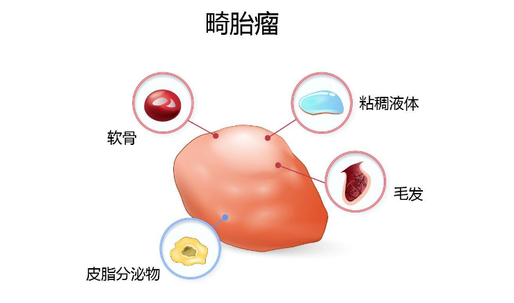 孩子长了畸胎瘤是遗传于母亲多还是父亲多呢？