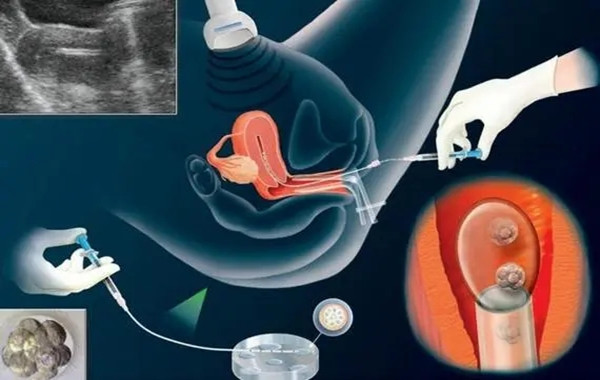 移植囊胚需要根据女性身体情况判断