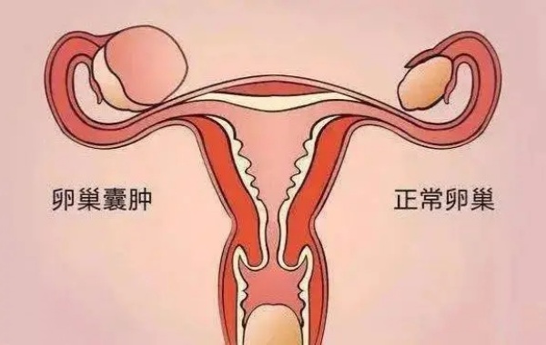 4厘米卵巢囊肿可以做二代试管