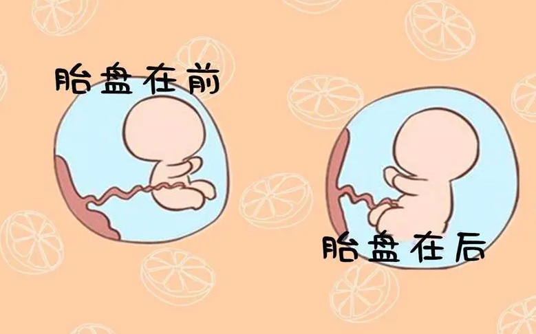 子宫前壁可能与子宫前凸有关