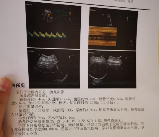 B超检查可以观察宝宝的生长发育