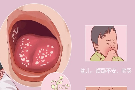 有鹅口疮宝宝会哭闹