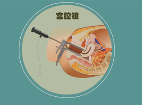 宫腔镜可以检查出子宫病变情况