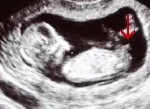 通过B超图像可以看出胎儿男女