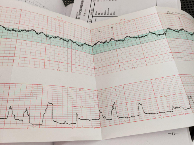 胎心监护检查报告单