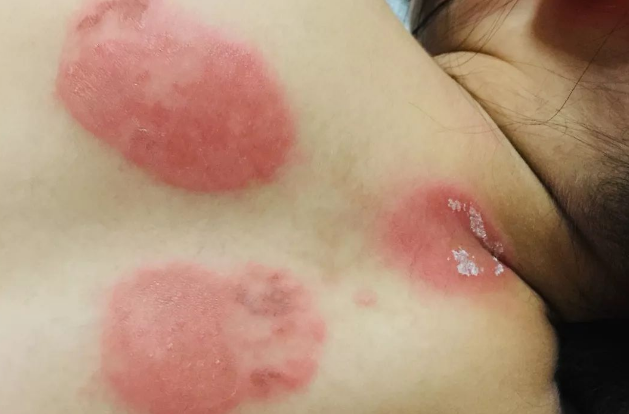 儿童对三伏贴过敏