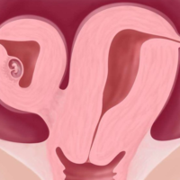 患有单角子宫做试管成功率多少？如何提高试管婴儿成功率？
