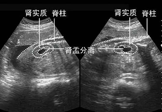 怀女宝可能会出现肾盂分离