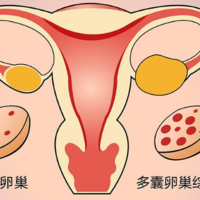 同时患有多囊卵巢和输卵管堵塞做几代试管婴儿成功率较高？