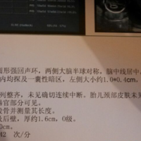 为啥周围的姐妹都说脑中线居中一定怀的是男孩？