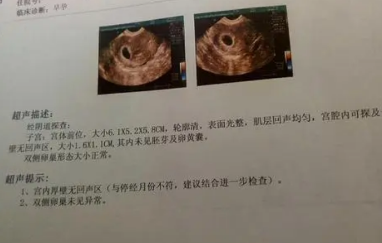 有卵黄囊不一定胎儿就稳了