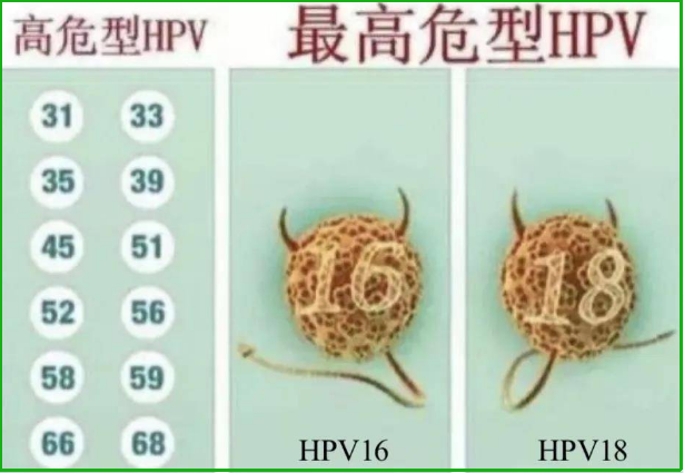 有高危HPV亚型阳性患宫颈癌的概率高